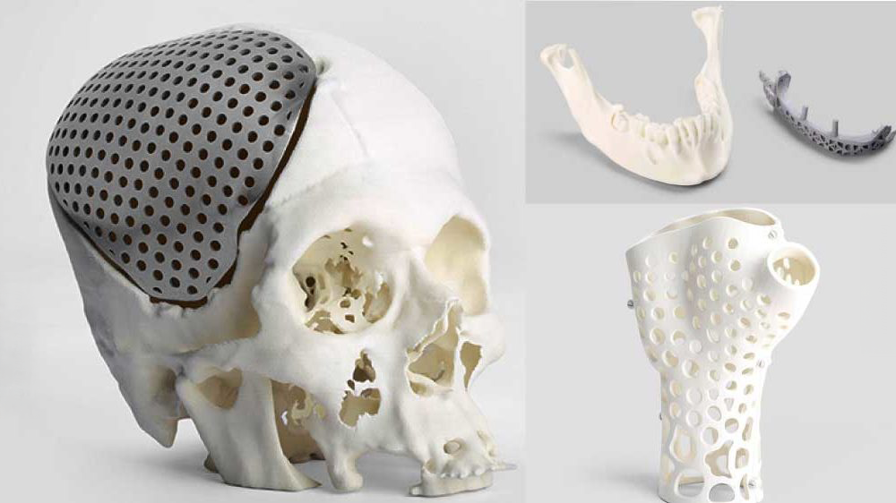Applications médicales de l’impression 3D et implants personnalisés